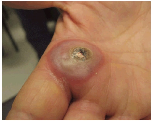 The figure shows a bulla caused by orf virus infection after puncture by a bone of a recently slaughtered goat in Greece in 2009. Two weeks later, the woman whose hand was infected traveled to Pennsylvania to visit her son. By that time, a large bulla had developed at the wound site. The bulla was examined at an emergency department and samples sent to CDC tested positive for orf.